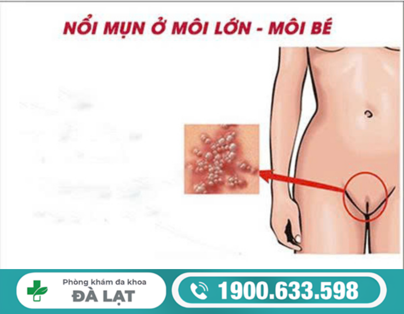 NỔI MỤN Ở MÔI BÉ CẢNH BÁO BỆNH LÝ PHỤ KHOA GÌ?