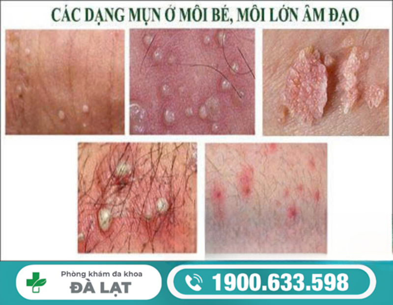 NỔI HẠT TRẮNG Ở MÔI LỚN LÀ DẤU HIỆU BỆNH GÌ?