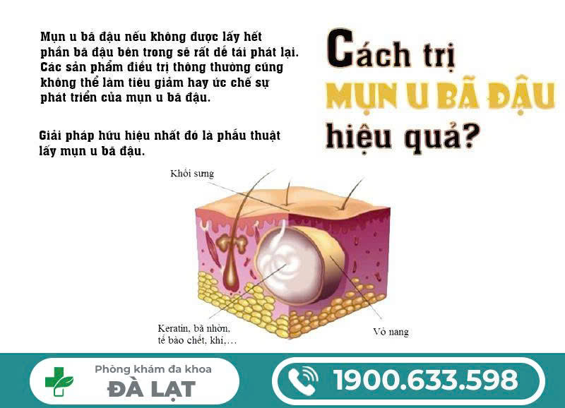 MỤN BÃ ĐẬU Ở VÙNG KÍN