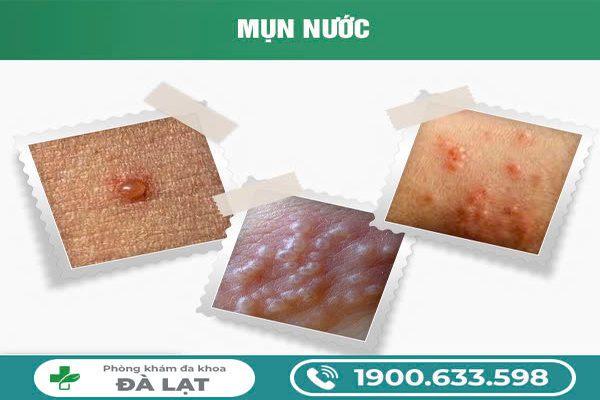 Nổi Mụn Nước Bộ Phận Sinh Dục ở cả Nam và Nữ 