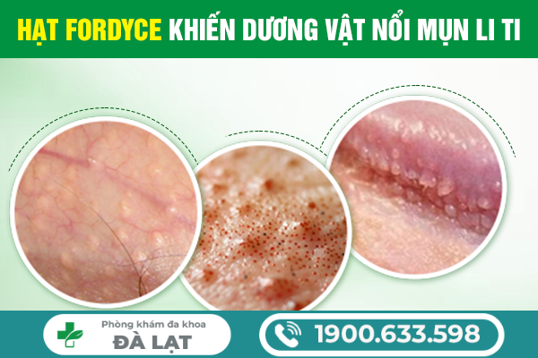 MỤN CƠM Ở VÙNG KÍN