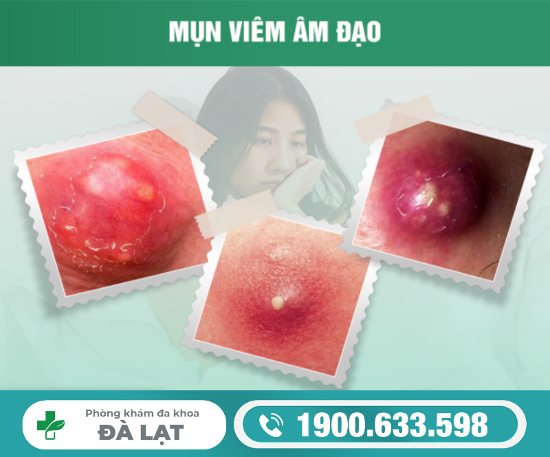 Nổi Mụn Mủ Ở Âm Đạo Nữ Giới 