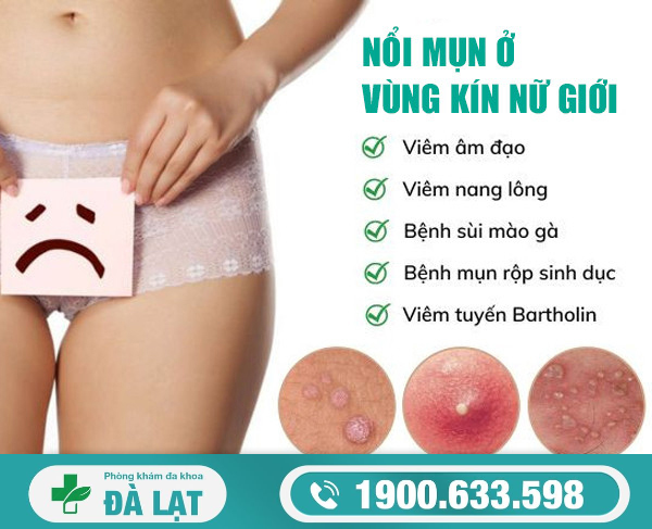 Âm Đạo Bị Nổi Mụn Bọc Ở Nữ Giới 