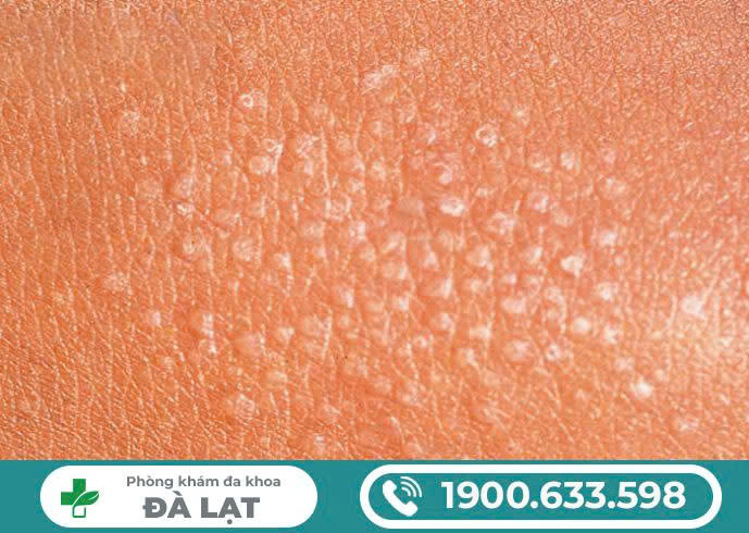 Âm Đạo Nổi Mụn LiTi Ở Nữ Giới 