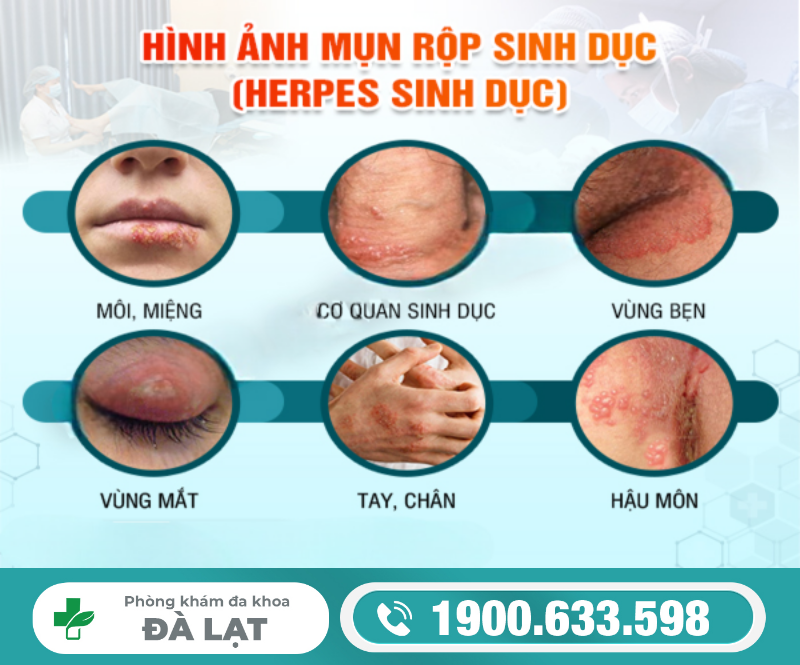 MỤN RỘP SINH DỤC Ở HẬU MÔN