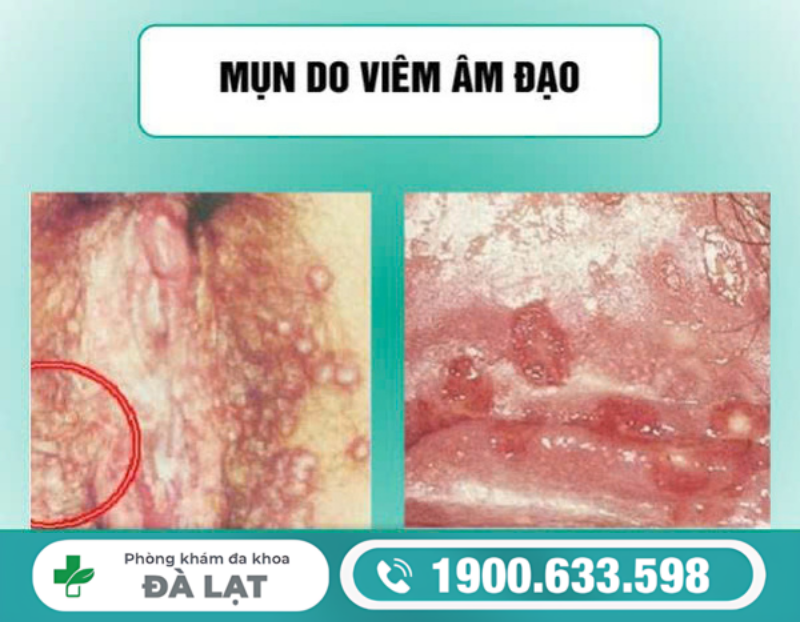 MỌC NỐT Ở ÂM ĐẠO LÀ DẤU HIỆU BỆNH PHỤ KHOA?