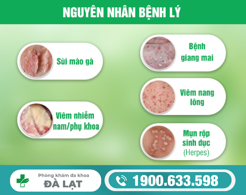 NỔI NỐT Ở BAO QUY ĐẦU LÀ DẤU HIỆU BỆNH GÌ?