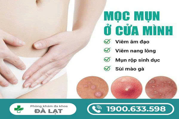 Nổi Mụn Ở Cửa Mình Nữ Giới