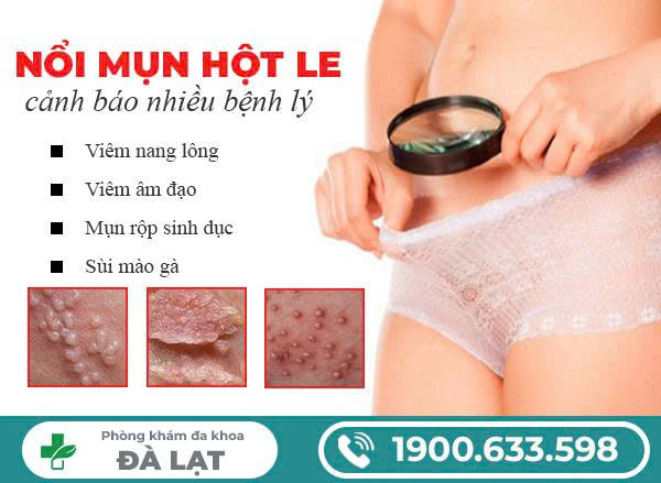 Nổi Mụn Ở Hột Le Nữ Giới
