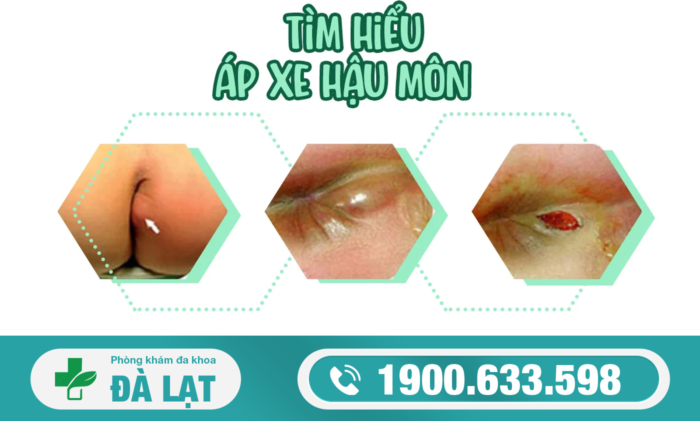 ÁP XE HẬU MÔN LÀ GÌ? NGUYÊN NHÂN, DẤU HIỆU VÀ CÁCH ĐIỀU TRỊ 