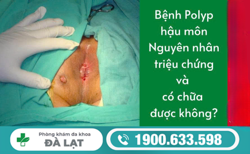POLYP HẬU MÔN LÀ GÌ? NGUYÊN NHÂN, DẤU HIỆU VÀ CÁCH ĐIỀU TRỊ 
