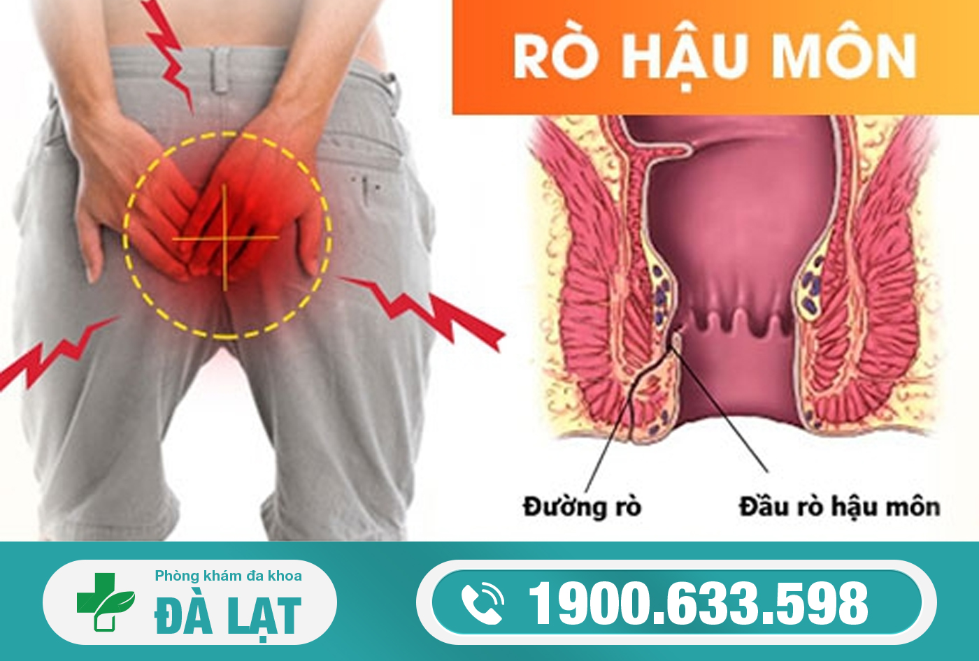 RÒ HẬU MÔN LÀ BỆNH GÌ? DẤU HIỆU, NGUYÊN NHÂN VÀ CÁCH ĐIỀU TRỊ 