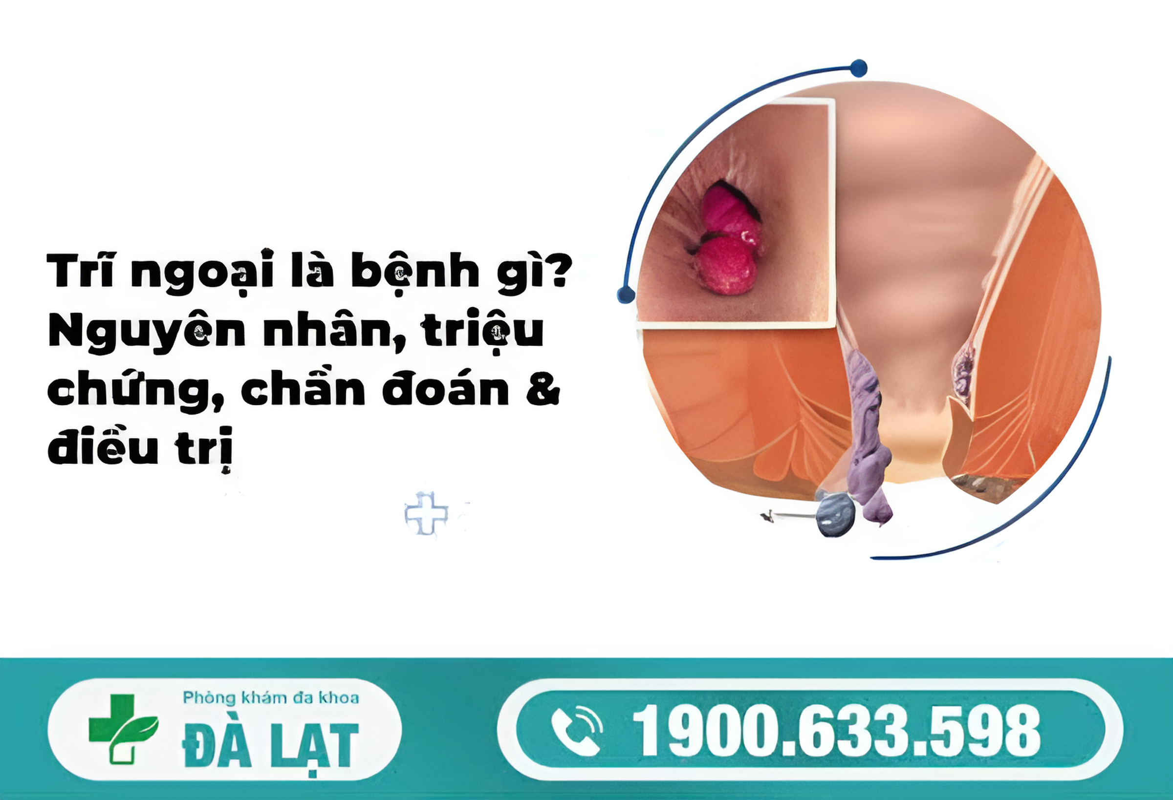 TRĨ NGOẠI: DẤU HIỆU, NGUYÊN NHÂN VÀ CÁCH ĐIỀU TRỊ 