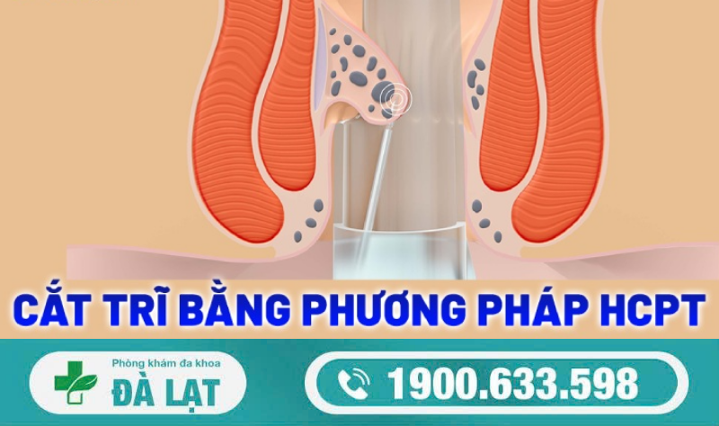 CẮT TRĨ: KHI NÀO NÊN THỰC HIỆN VÀ NHỮNG ĐIỀU CẦN BIẾT 