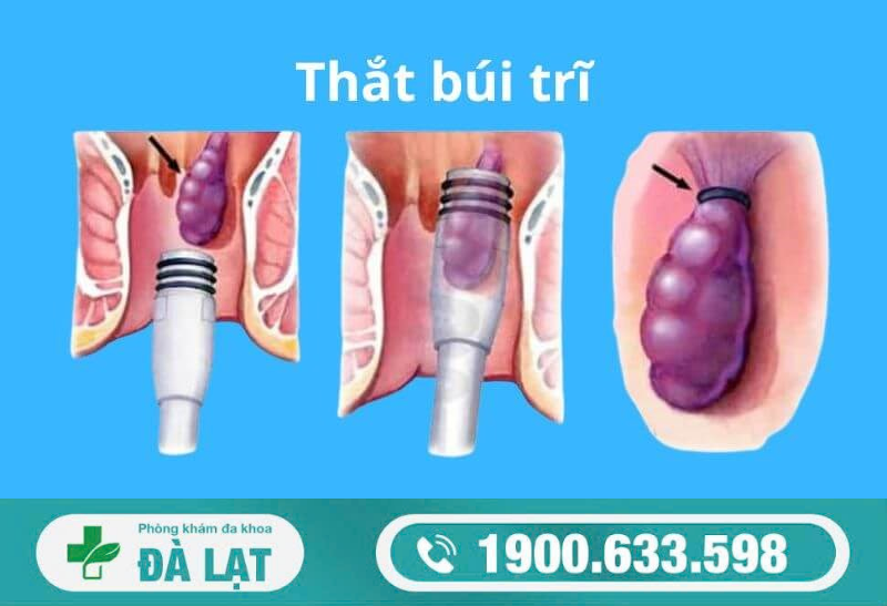 THẮT TRĨ LÀ GÌ? CÓ HIỆU QUẢ HAY KHÔNG?