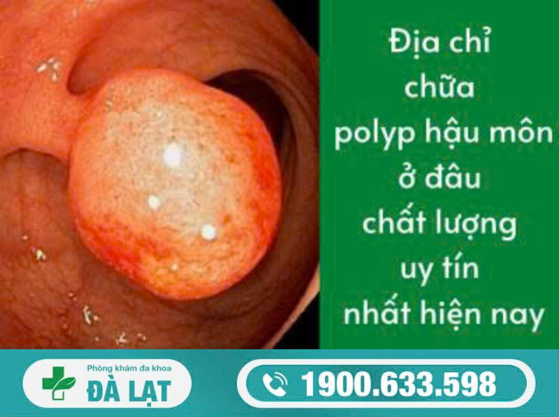 GIẢI ĐÁP: KHÁM POLYP HẬU MÔN Ở ĐÂU UY TÍN?