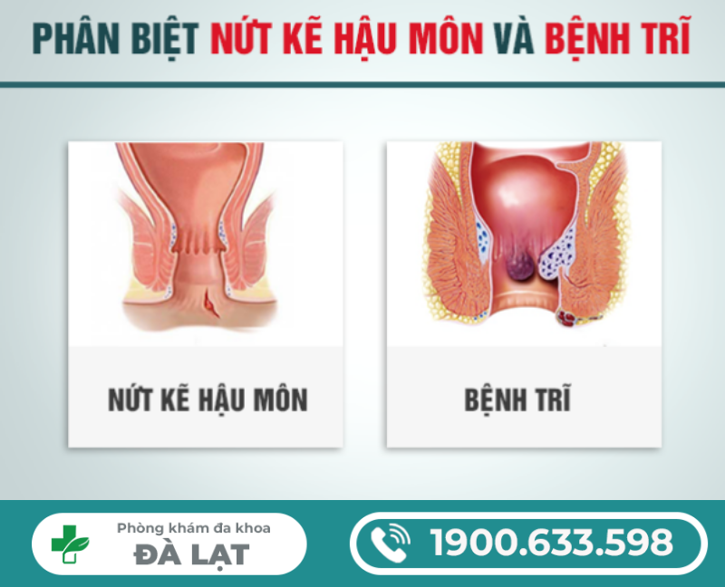 PHÂN BIỆT TRĨ VÀ NỨT KẼ HẬU MÔN: NHẬN BIẾT ĐÚNG ĐỂ TRÁNH NHẦM LẪN