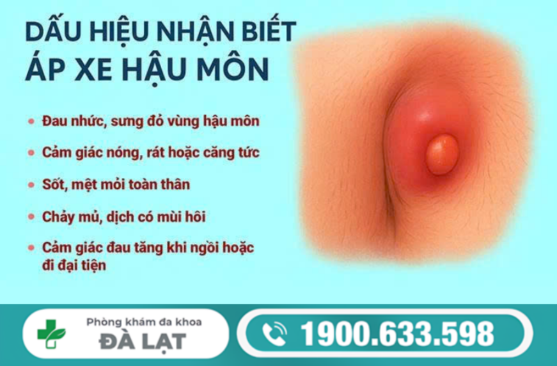 DẤU HIỆU ÁP XE HẬU MÔN THƯỜNG GẶP 