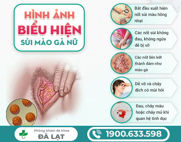 CÁCH CHỮA BỆNH SÙI MÀO GÀ Ở NỮ GIỚI