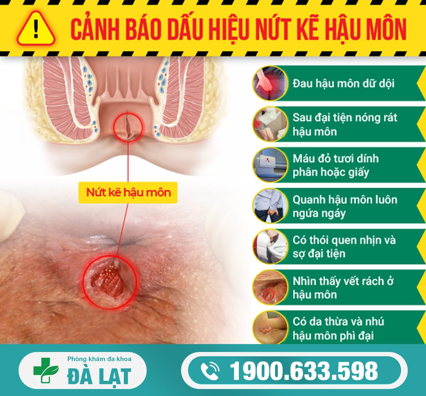 CÁC DẤU HIỆU NHẬN BIẾT NỨT KẼ HẬU MÔN    