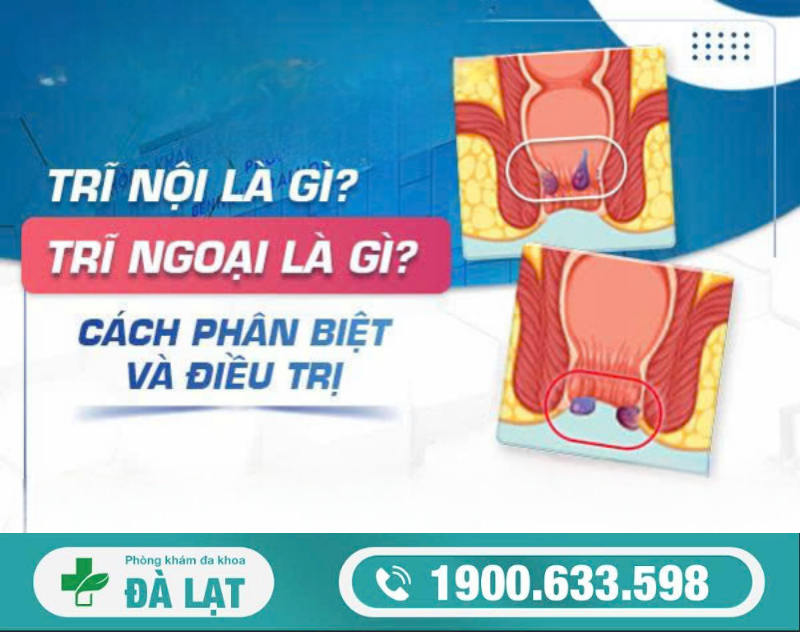 PHÂN BIỆT TRĨ NỘI VÀ TRĨ NGOẠI     