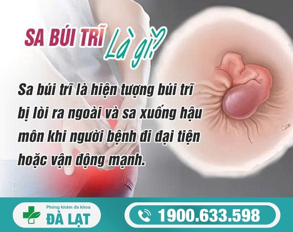 SA BÚI TRĨ: NGUYÊN NHÂN VÀ CÁCH ĐIỀU TRỊ HIỆU QUẢ