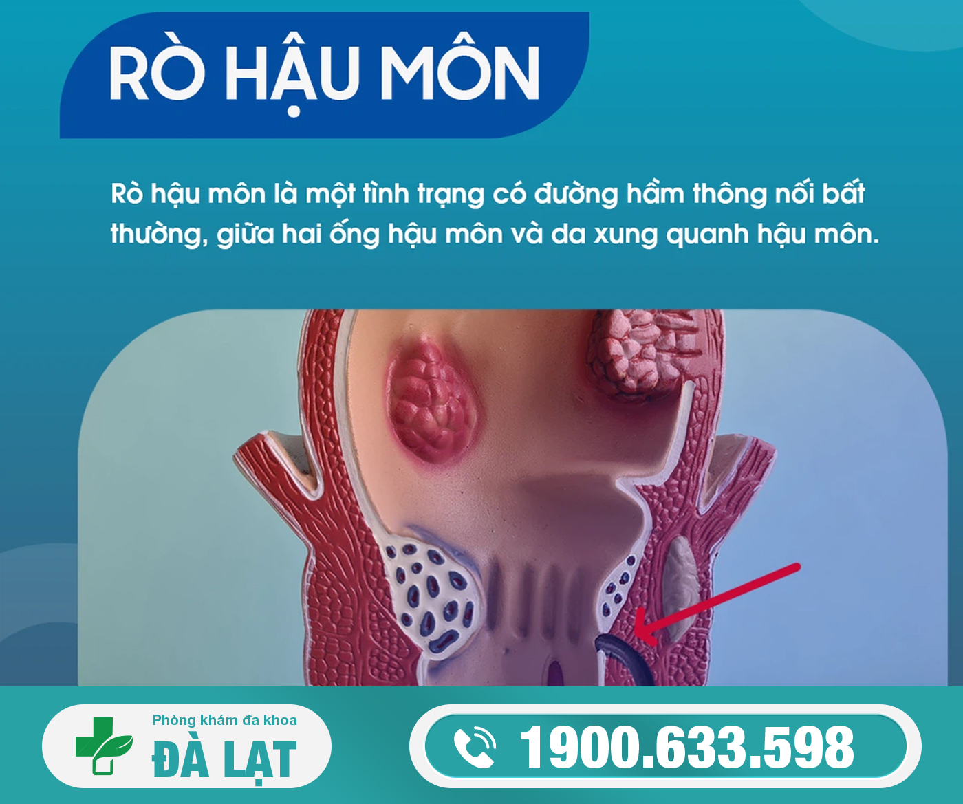 HỞ VAN HẬU MÔN: DẤU HIỆU, NGUYÊN NHÂN VÀ CÁCH ĐIỀU TRỊ HIỆU QUẢ